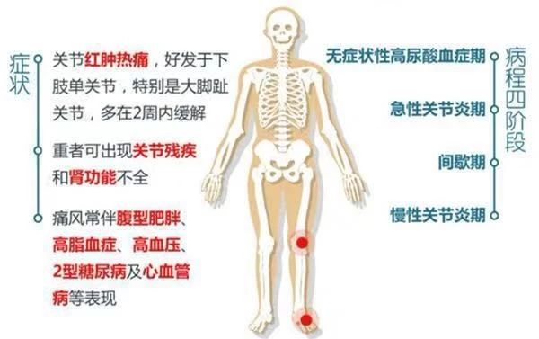 痛风性关节炎发作怎么办？中医这么说