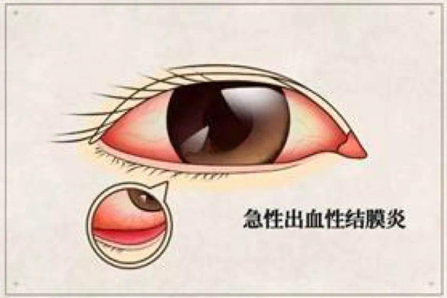 传染性强，还可能在学校、泳池暴发，这种病如何预防→
