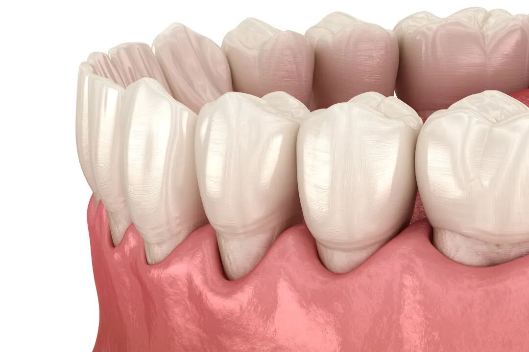 牙龈萎缩了，还能再“长”回来吗？