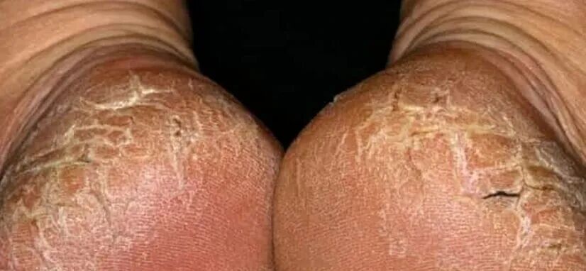 脚后跟总开裂起皮,不一定是干燥造成的!小心这几种疾病