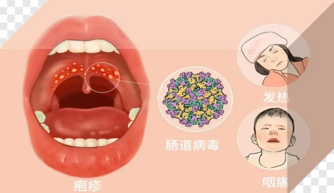 孩子嘴里长疱疹就是得了手足口病?不一定,别忽略它→