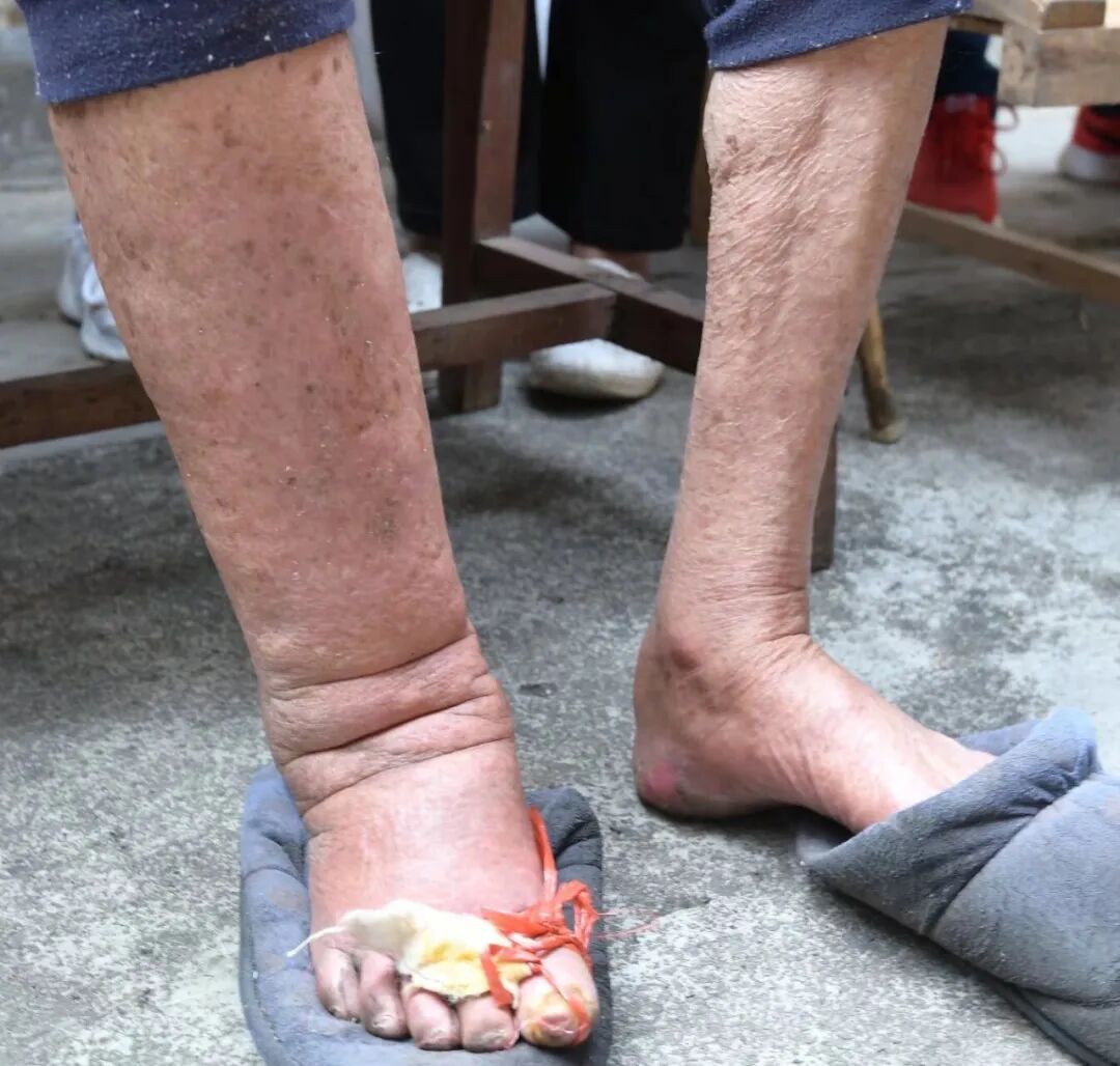 这种蚊媒传染病可致淋巴水肿，我国已消除，出国旅行仍需警惕